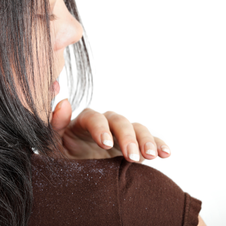 A woman with long dark hair touching her shoulder, showing visible dandruff.